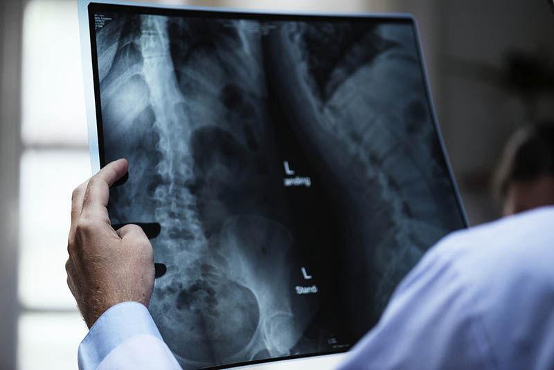 Csonthártyagyulladás – egy nagyon komoly betegség